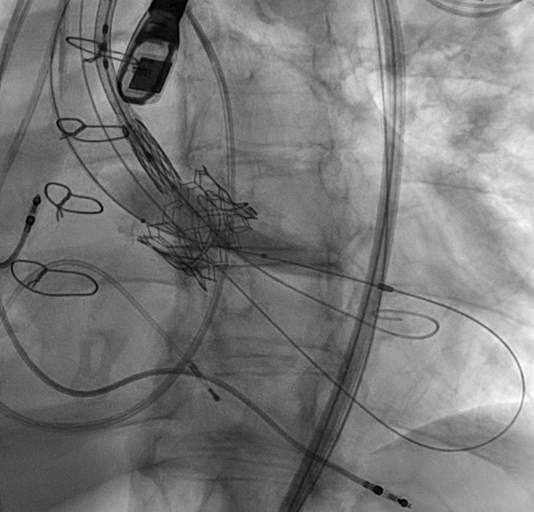 Fluoroscopic image from a structural heart procedure