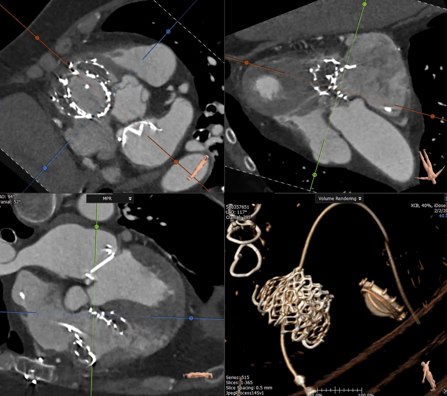 Multi-plane CT reconstruction used for procedural planning