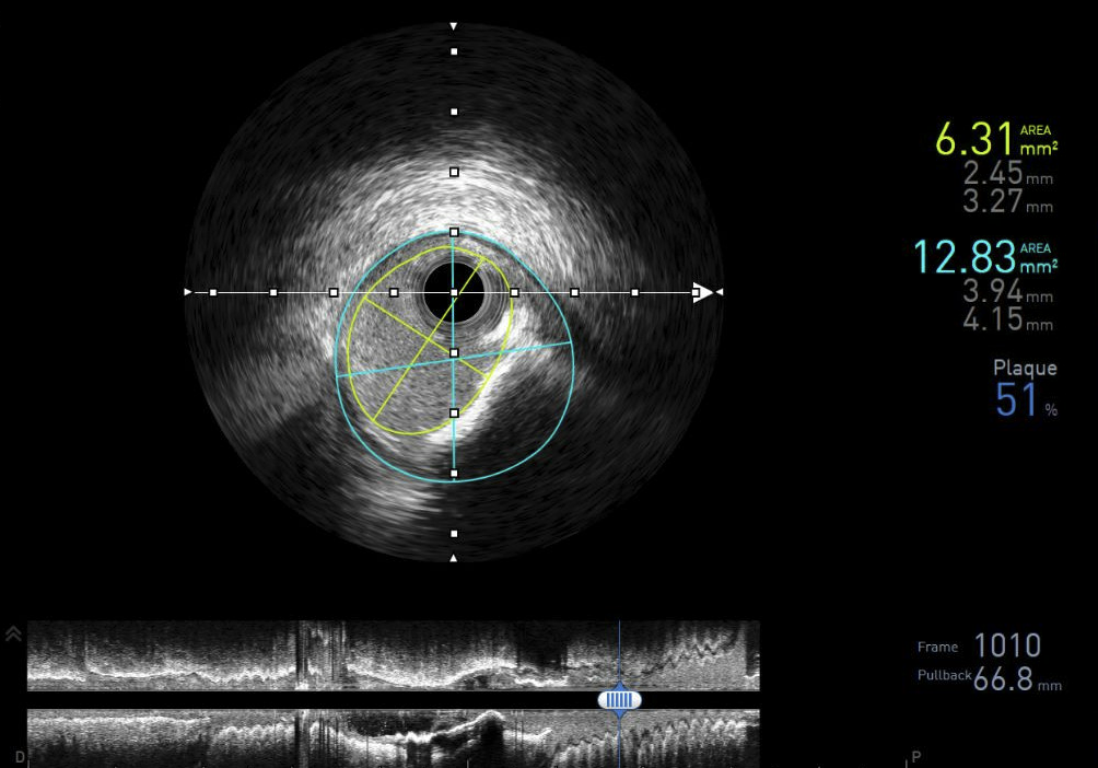 Intravascular ultrasound cross-section with lumen and plaque measurements