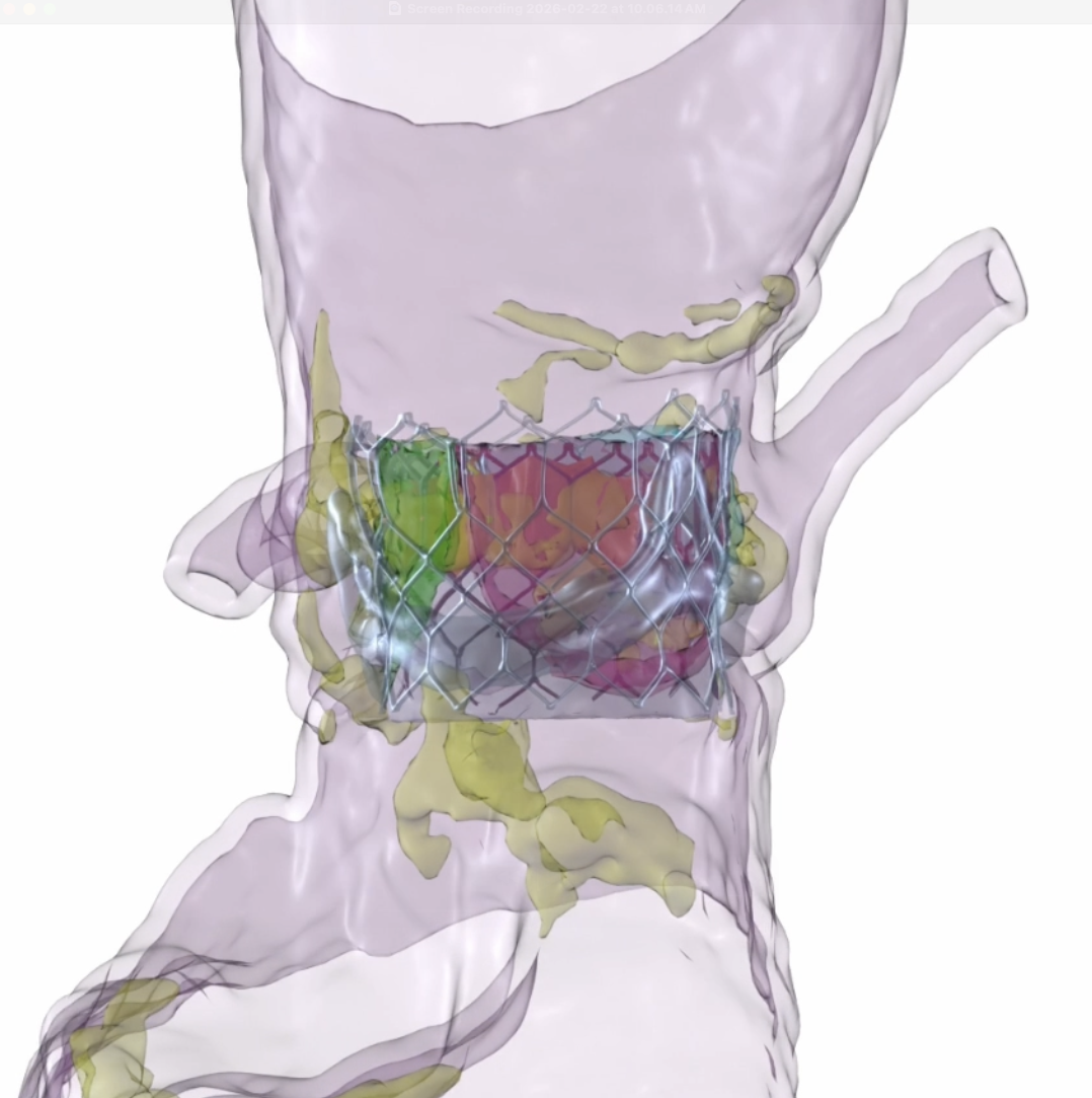 3D CT reconstruction of a transcatheter valve deployment